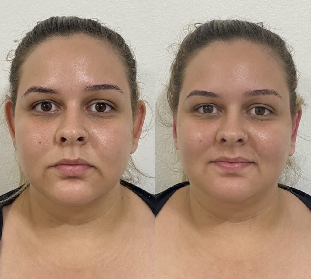 Procedimento corrige orelhas de abano sem necessidade de cirurgia Beleza