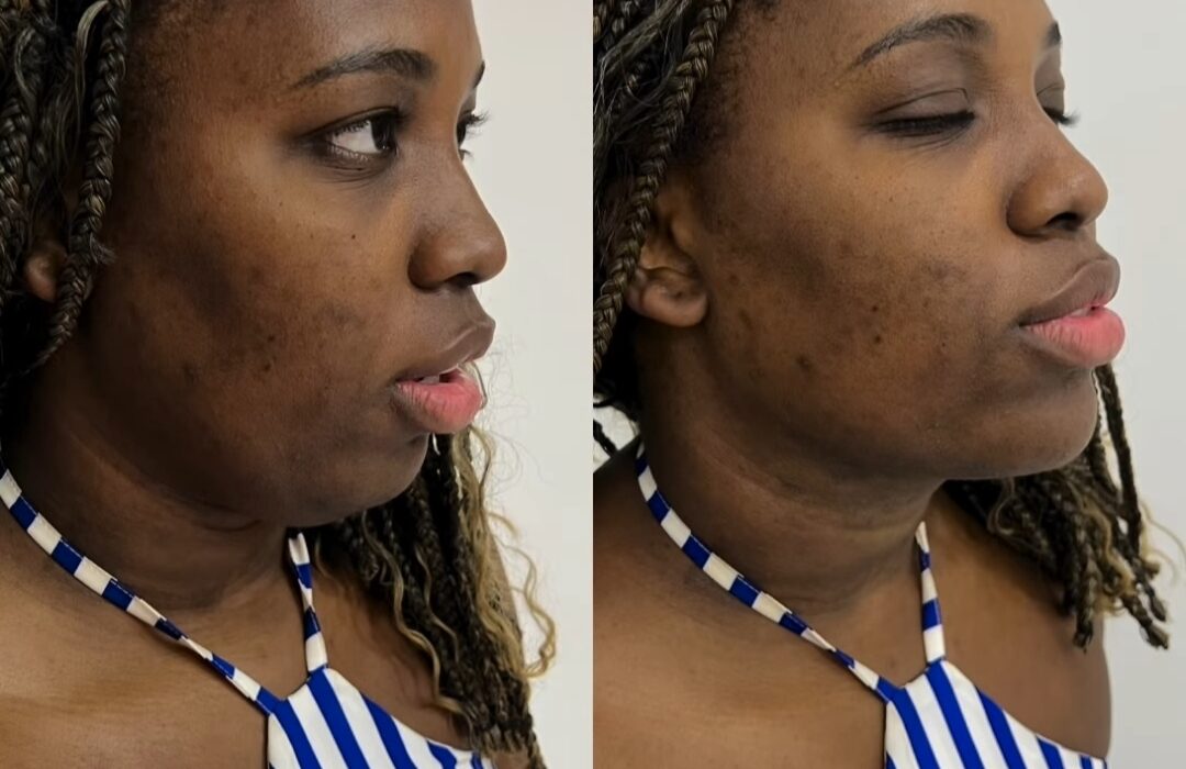 (Antes e depois) Leidy Elin realiza sonho de lipoaspiração de papada: "Cuidar da aparência é sinal de amor próprio" Beleza