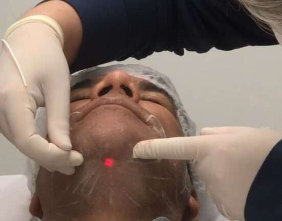 Endolaser surge como alternativa menos invasiva para tratar papada, pequenas gorduras localizadas e flacidez Geral