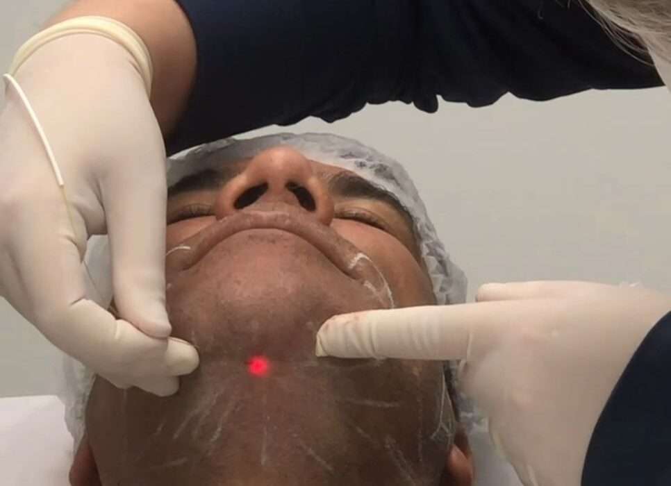 Endolaser surge como alternativa menos invasiva para tratar papada, pequenas gorduras localizadas e flacidez Saúde